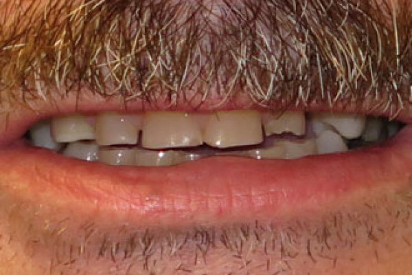 Battle Ground Full Mouth Reconstruction