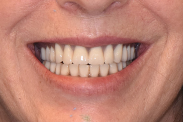 Above & Beyond Dentistry & Implants | Chao Pinhole® Gum Rejuvenation, Full Mouth Reconstruction and Extractions