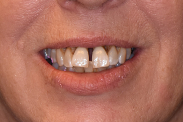 Above & Beyond Dentistry & Implants | Teeth Whitening, Veneers and Tooth Colored Fillings