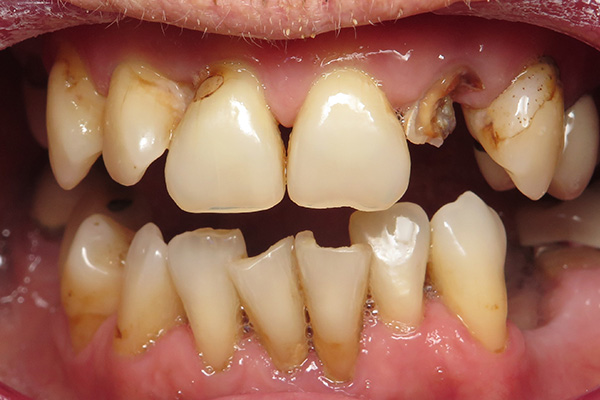Battle Ground Full Mouth Reconstruction