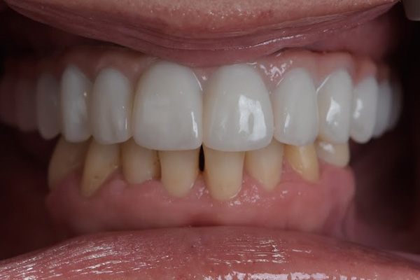 Above Beyond Dentistry Implants | Root Canals, Dental Implants and All-on-X reg