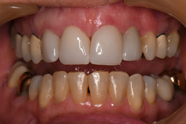 Above Beyond Dentistry Implants | Gum Disease, All-on-X reg and Full Mouth Reconstruction