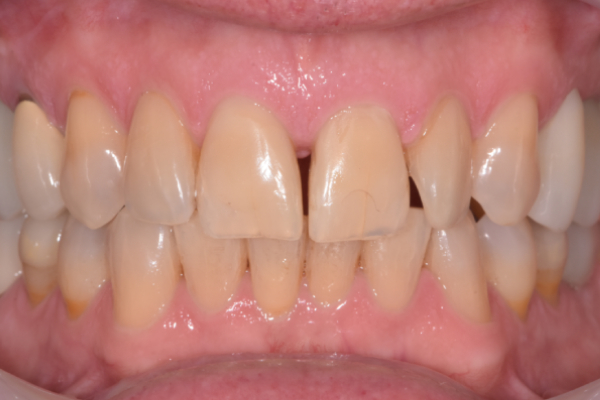 Pediatric Dentist near Battle Ground